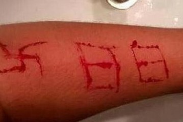 Un adolescent agressé par 3 néonazis qui ont gravé sur sa peau une croix gammée au rasoir…