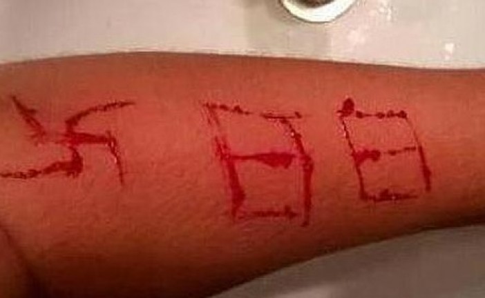 Un adolescent agressé par 3 néonazis qui ont gravé sur sa peau une croix gammée au rasoir…